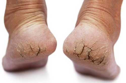 Chuyên gia khuyến cáo, giữ ấm bàn chân mùa đông như bảo vệ trái tim mình