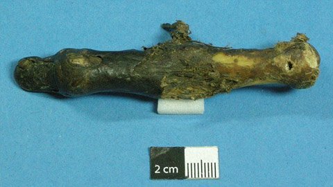 Câu chuyện ly kỳ về ngón tay người tuyết