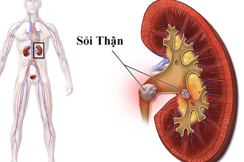 Nguy cơ sỏi thận vì 3 thói quen hầu như ai cũng mắc phải
