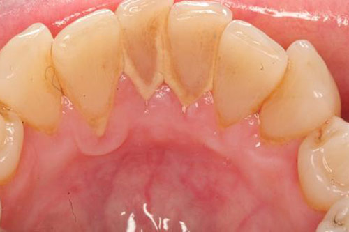 Bày cách siêu đơn giản ‘xua đuổi’ nỗi sợ hãi mang tên ‘cao răng’