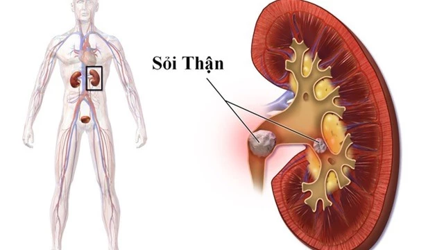 Nguy cơ sỏi thận vì 3 thói quen hầu như ai cũng mắc phải