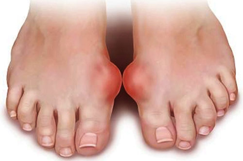 15 bài thuốc trị bệnh gout giúp hàng ngàn người khỏi bệnh