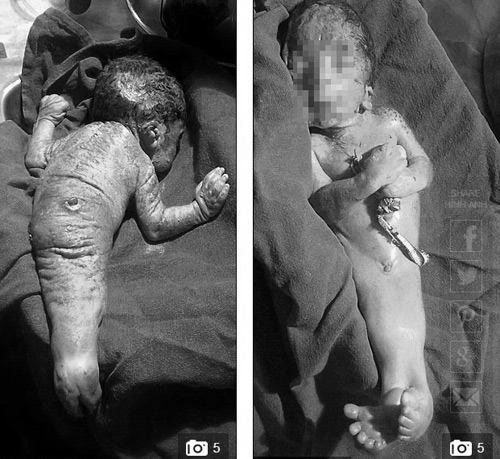 Những em bé chào đời trong hình hài người cá