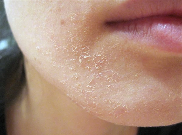 Làn da khô thường xuyên bị nứt nẻ, bong tróc vào mùa lạnh