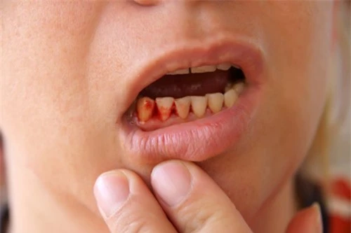 Xỉa răng bằng tăm gây hại cho lợi và xương