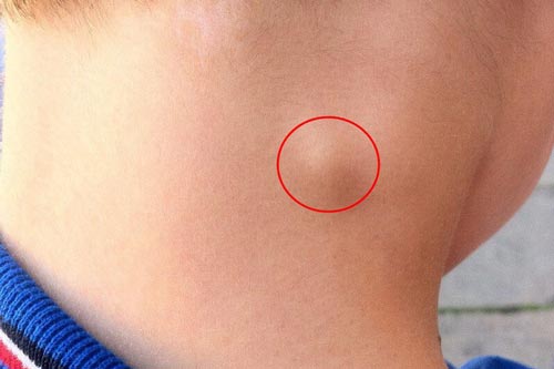 3 dấu hiệu bất thường trên cổ cảnh báo khối u đang phát triển, bạo bệnh có thể bùng phát bất cứ lúc nào