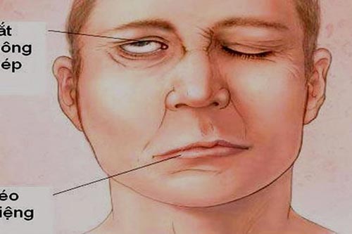 Làm những việc này khi trời lạnh có thể gây ra liệt mặt, méo miệng, nhiều người trẻ đang vô tình mắc phải