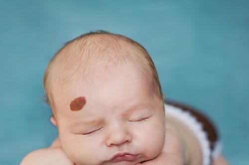 Tiết lộ ý nghĩa vết chàm, vết bớt trên cơ thể dự báo vận số tương lai