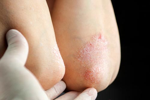 Vảy nến trong mùa đông: Nên và không nên làm gì để kiểm soát bệnh?