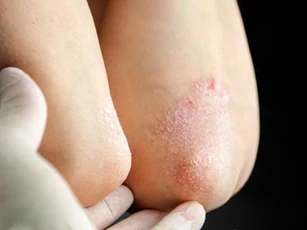 Vảy nến trong mùa đông: Nên và không nên làm gì để kiểm soát bệnh?