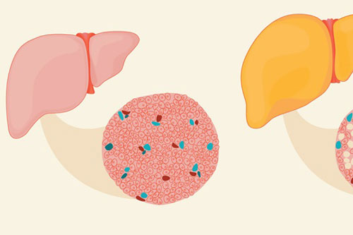 Nếu bạn là 1 trong 7 nhóm người này, nghĩa là bạn có nguy cơ cao mắc gan nhiễm mỡ