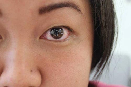 Giải mã tại sao có hiện tượng nháy, co giật mắt ở người