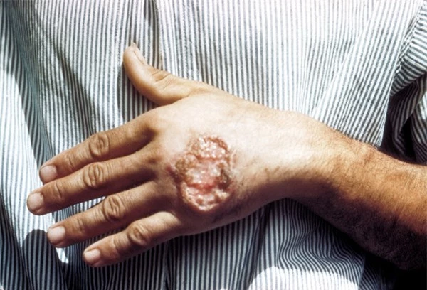 Khám phá thế giới về loài ký sinh trùng này làm gia tăng mối lo ngại các bệnh về da
