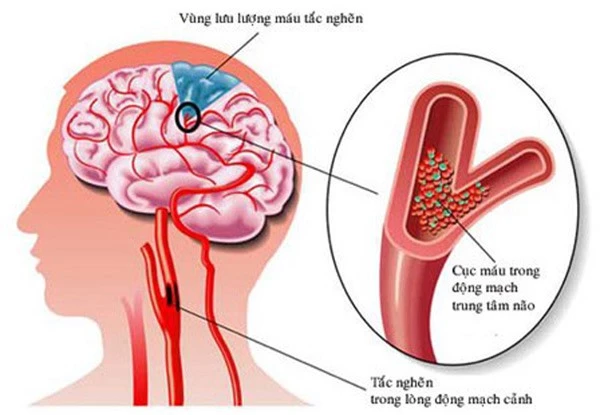 Nắng nóng 41 độ, cảnh báo 7 dấu hiệu sớm của đột quỵ