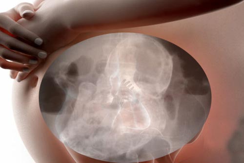 Bào thai hoá đá tồn tại suốt 15 năm trong bụng mẹ là có thật?