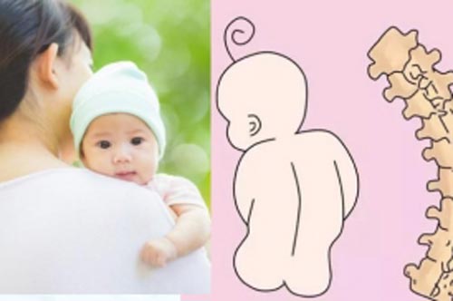 5 sai lầm tai hại của cha mẹ khiến con bị gù lưng, vẹo cột sống