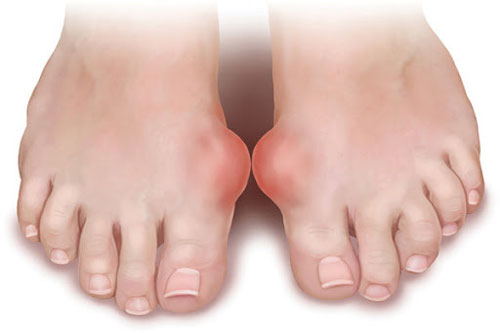 Thực phẩm người bị bệnh Gout không nên ăn