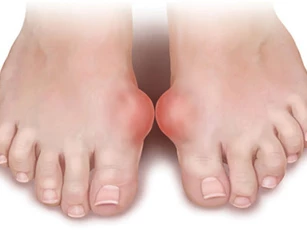 Thực phẩm người bị bệnh Gout không nên ăn