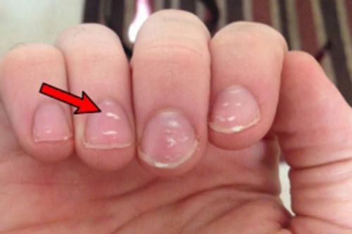 "Đốm trắng" xuất hiện dày đặc trên móng tay cảnh báo bạn đang mắc bệnh này