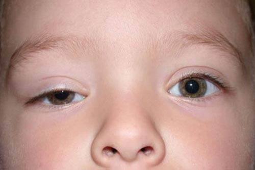 Sụp mí mắt: Đừng coi thường bệnh lý nguy hiểm