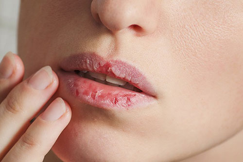 Giải quyết dứt điểm tình trạng môi khô