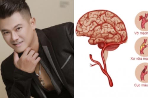 Từ trường hợp của ca sĩ Vân Quang Long: Cảnh báo 5 nhóm đối tượng dễ bị đột quỵ