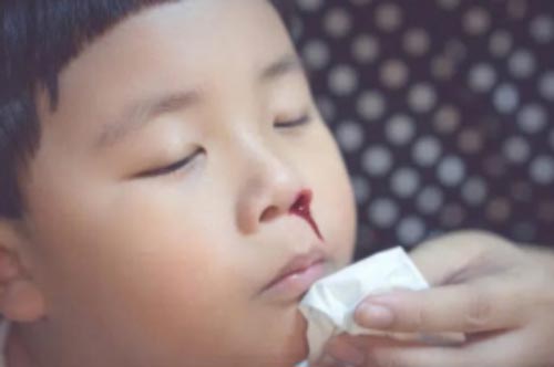 Cô giáo cho bé mầm non ngửa đầu khi chảy máu cam: Bác sĩ mắng té tát khi thấy tình trạng của đứa trẻ