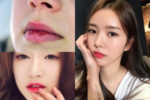 5 nguyên nhân gây nứt nẻ môi và cách khắc phục tại nhà hiệu quả