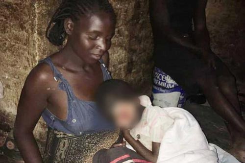 Lý giải 'bệnh lạ' do di truyền cứ ra ngoài nắng là bị 'tan chảy'