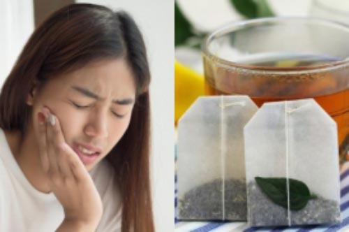 Giảm đau răng khôn đơn giản bằng những nguyên liệu có sẵn trong nhà