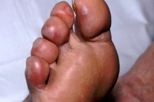 Mẹo hay phòng tránh bệnh cước chân, tay mùa đông