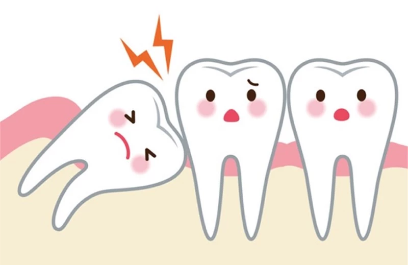 Mọc răng khôn có thể gây ra nhiều đau đớn.