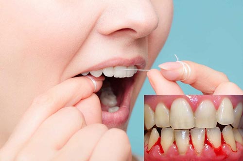 Dùng chỉ nha khoa sai cách có thể gây nhiễm trùng nướu nghiêm trọng