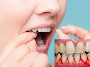 Dùng chỉ nha khoa sai cách có thể gây nhiễm trùng nướu nghiêm trọng