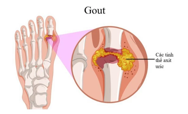 5-benh-nguy-hiem-khi-an-qua-nhieu-thit-02