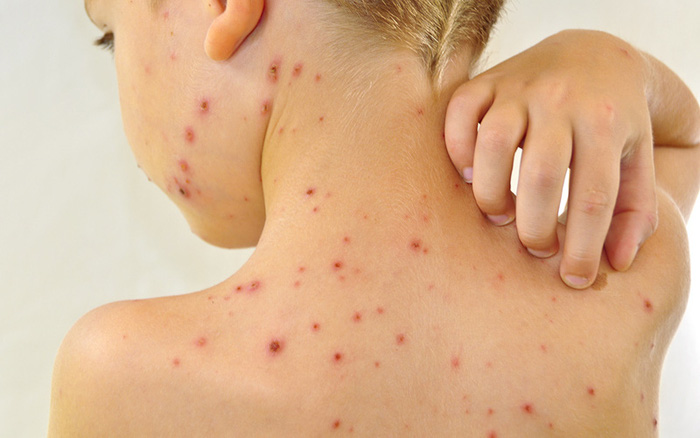 Cách phân biệt thủy đậu và sốt phát ban