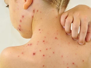 Cách phân biệt thủy đậu và sốt phát ban