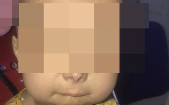 Bé 6 tuổi ở Hà Nội có nhiều bộ phận lão hóa như người già