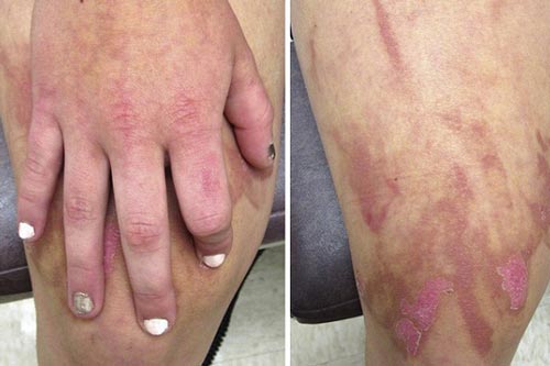 Ngò tây, chanh, củ cải, thì là… có thể gây bỏng rát, thậm chí mù vĩnh viễn