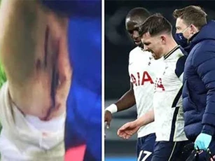 Hojbjerg chấn thương ghê rợn trong ngày Tottenham đánh bại Brentford