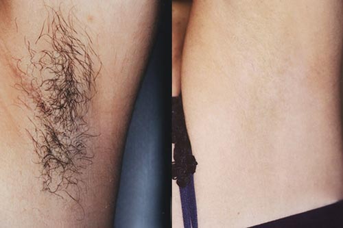 Cả đời không cần dùng nhíp nhổ lông nách nếu biết mẹo này