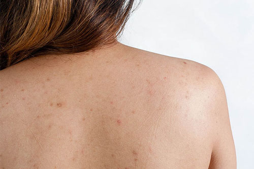 Trị thâm mụn vùng lưng hiệu quả bằng cách đơn giản