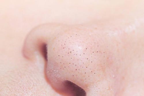 Đánh bay mụn đầu đen chỉ bằng cách dùng cơm nóng