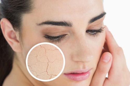 Ai dễ bị khô da, nứt nẻ?