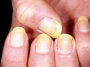 Cách "xử lý" móng tay ngả vàng đơn giản nhất