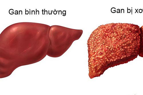5 nguyên nhân gây xơ gan hàng đầu ở nước ta