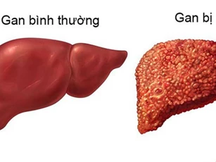 5 nguyên nhân gây xơ gan hàng đầu ở nước ta