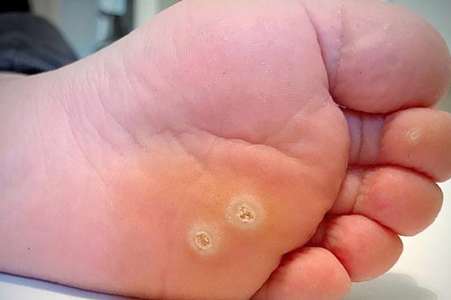 2 cách trị mụn cóc tại nhà ai cũng làm được