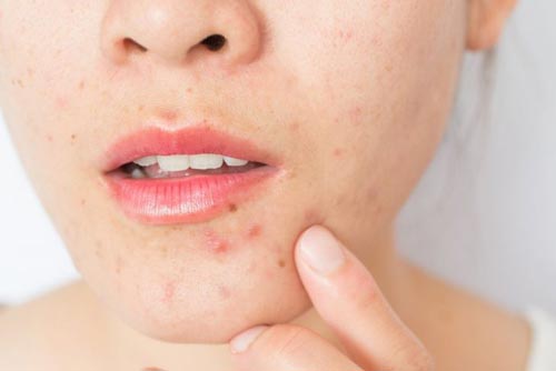 Bí quyết để nặn mụn không để lại vết thâm