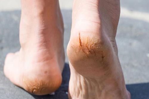 Cách chữa nứt gót chân mùa hanh khô cực đơn giản